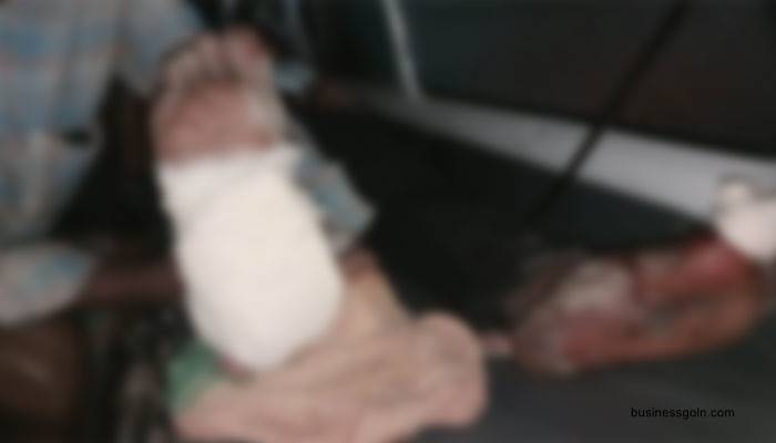 কুড়িয়ে পাওয়া মর্টারশেলকে গুপ্তধন ভেবে কাটতে গিয়ে পা বিচ্ছিন্ন