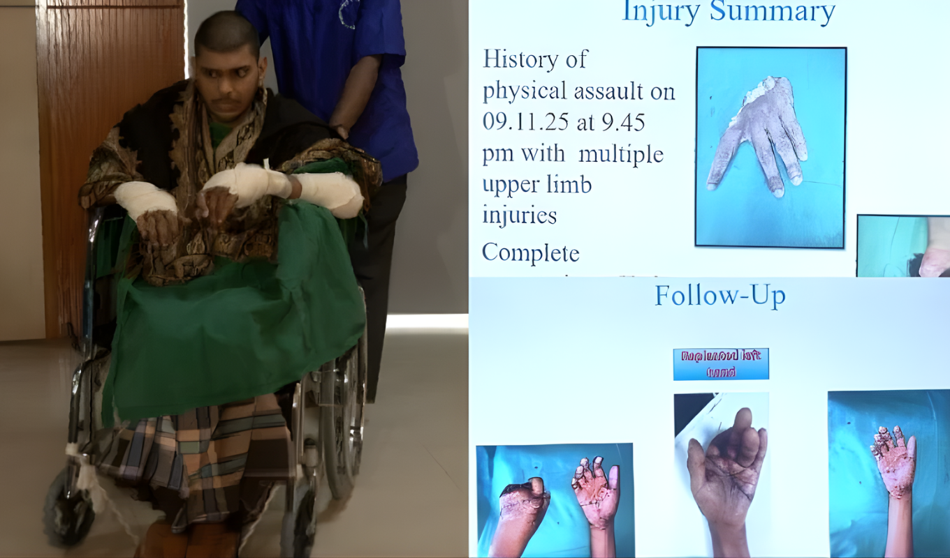 বিচ্ছিন্ন হাত পুনঃস্থাপনে ইতিহাস রাঙালো বার্ন ইনস্টিটিউট বিচ্ছিন্ন হাত পুনঃস্থাপনে ইতিহাস রাঙালো বার্ন ইনস্টিটিউট