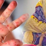 Measles Outbreak Escalates In Cumilla As Infant Dies কুমিল্লায় হামের প্রকোপে শিশুমৃত্যু, ২৪ ঘণ্টায় নতুন ৫০ রোগী শনাক্ত