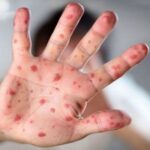 Seven Children Die from Measles and Related Symptoms হাম আক্রান্তে সাত শিশু মৃত্যু