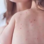 রাজশাহীতে হামে শিশু মৃত্যুর উদ্বেগ বৃদ্ধি রাজশাহীতে হামে শিশু মৃত্যুর উদ্বেগ বৃদ্ধি