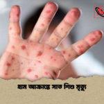 হাম আক্রান্তে সাত শিশু মৃত্যু হাম আক্রান্তে সাত শিশু মৃত্যু