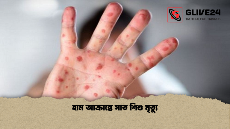 হাম আক্রান্তে সাত শিশু মৃত্যু হাম আক্রান্তে সাত শিশু মৃত্যু