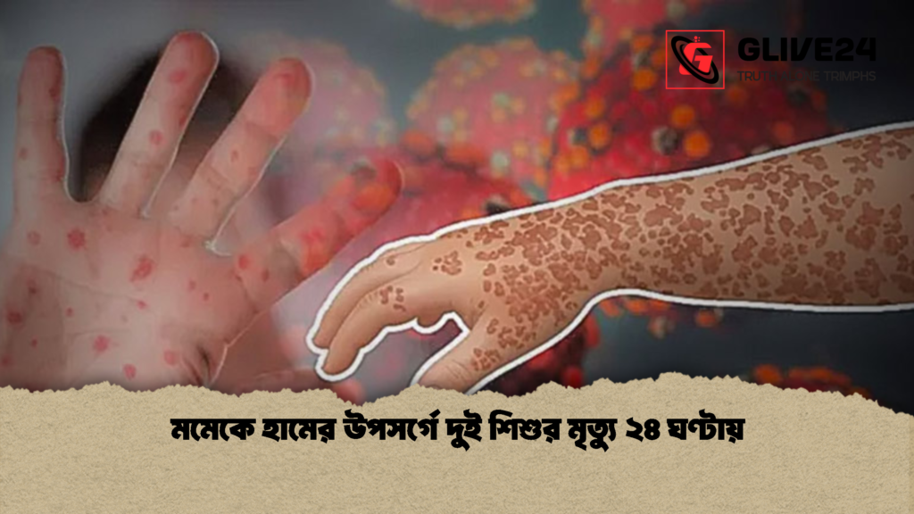 মমেকে হামের উপসর্গে দুই শিশুর মৃত্যু ২৪ ঘণ্টায় 1 মমেকে হামের উপসর্গে দুই শিশুর মৃত্যু ২৪ ঘণ্টায়