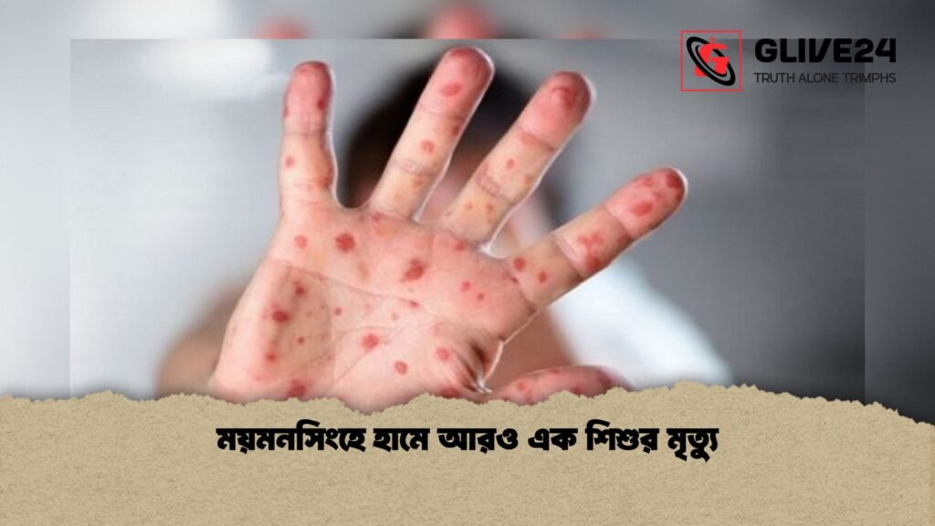 ময়মনসিংহে হামে আরও এক শিশুর মৃত্যু 1 ময়মনসিংহে হামে আরও এক শিশুর মৃত্যু