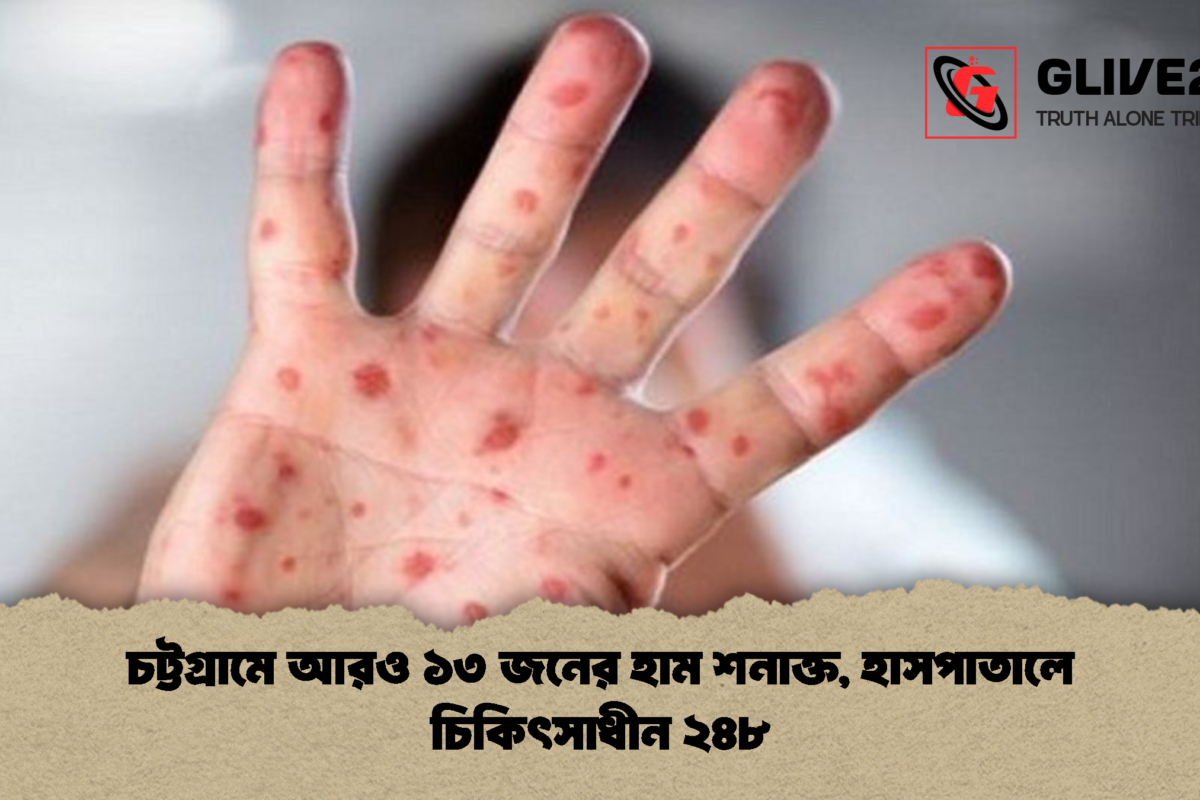 চট্টগ্রামে আরও ১৩ জনের হাম শনাক্ত, হাসপাতালে চিকিৎসাধীন ২৪৮