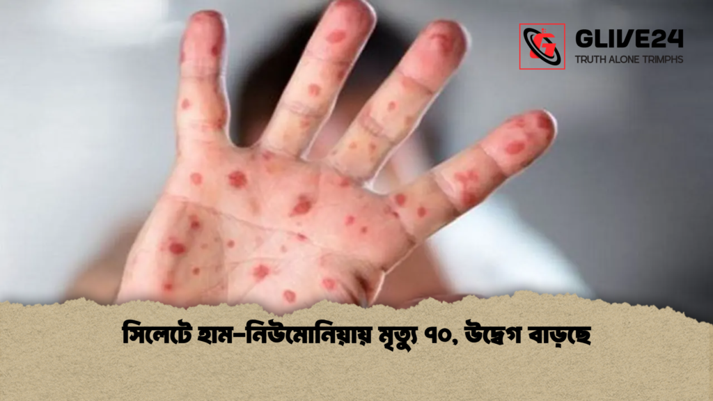 সিলেটে হাম নিউমোনিয়ায় মৃত্যু ৭০ উদ্বেগ বাড়ছে সিলেটে হাম-নিউমোনিয়ায় মৃত্যু ৭০, উদ্বেগ বাড়ছে