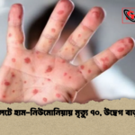 সিলেটে হাম নিউমোনিয়ায় মৃত্যু ৭০ উদ্বেগ বাড়ছে সিলেটে হাম-নিউমোনিয়ায় মৃত্যু ৭০, উদ্বেগ বাড়ছে