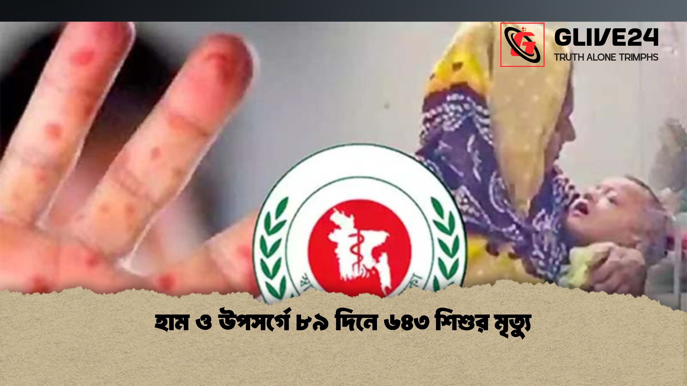 হাম ও উপসর্গে ৮৯ দিনে ৬৪৩ শিশুর মৃত্যু