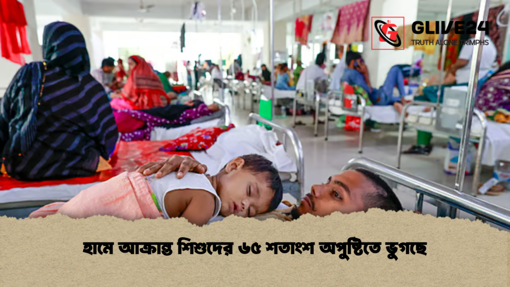 হামে আক্রান্ত শিশুদের ৬৫ শতাংশ অপুষ্টিতে ভুগছে হামে আক্রান্ত শিশুদের ৬৫ শতাংশ অপুষ্টিতে ভুগছে