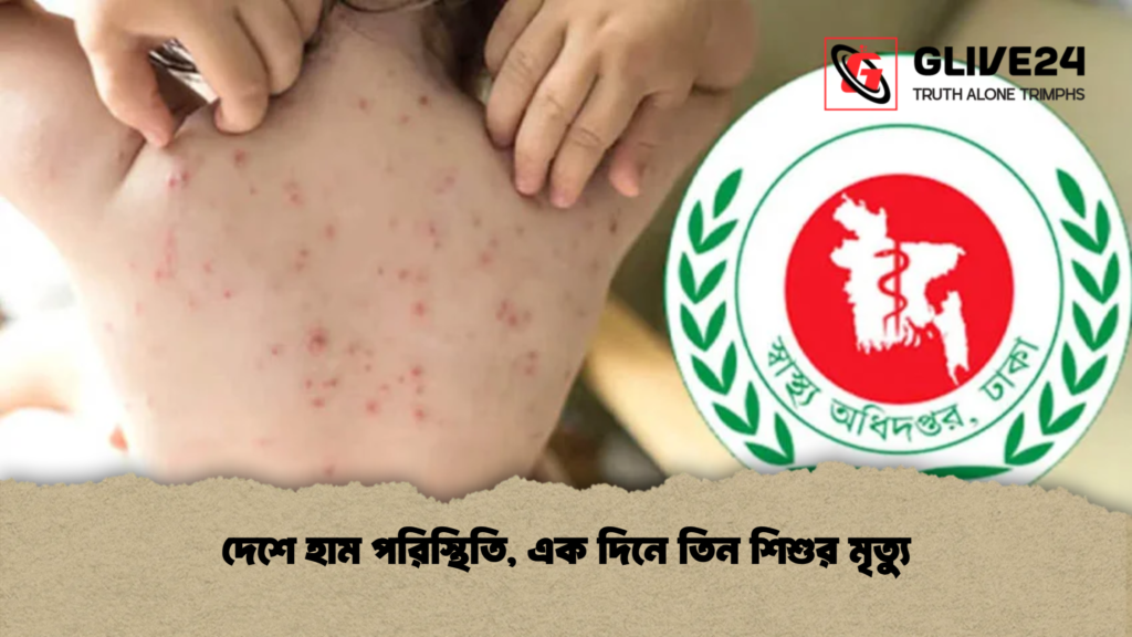 দেশে হাম পরিস্থিতি এক দিনে তিন শিশুর মৃত্যু দেশে হাম পরিস্থিতি, এক দিনে তিন শিশুর মৃত্যু