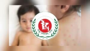 দেশে হামের প্রকোপ অব্যাহত, ২৪ ঘণ্টায় মৃত্যু ৩